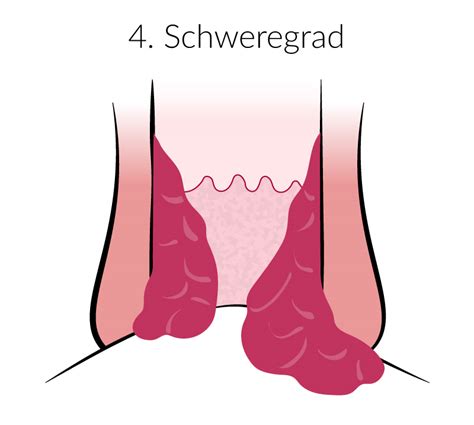 bilder von hämorrhoiden